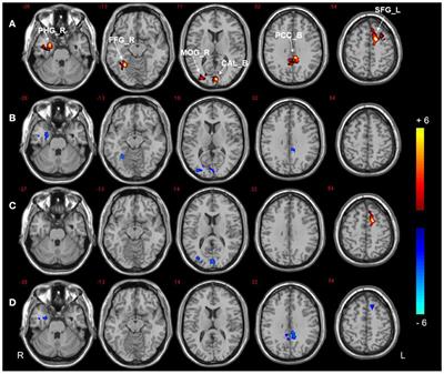 Altered functional hubs and connectivity in type 2 diabetes mellitus with and without mild cognitive impairment